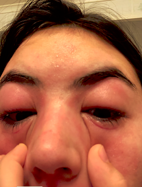 Emily's swollen eyes from eczema