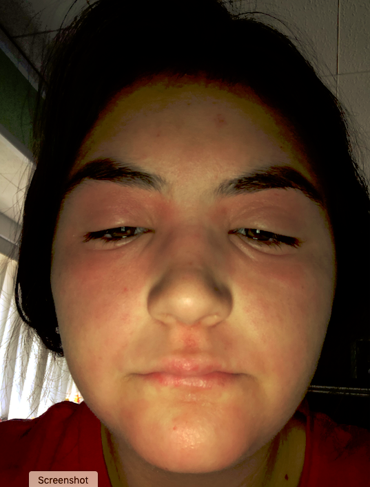 Emily's face swollen from eczema