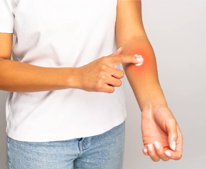 a woman pointing to irritation on her arm